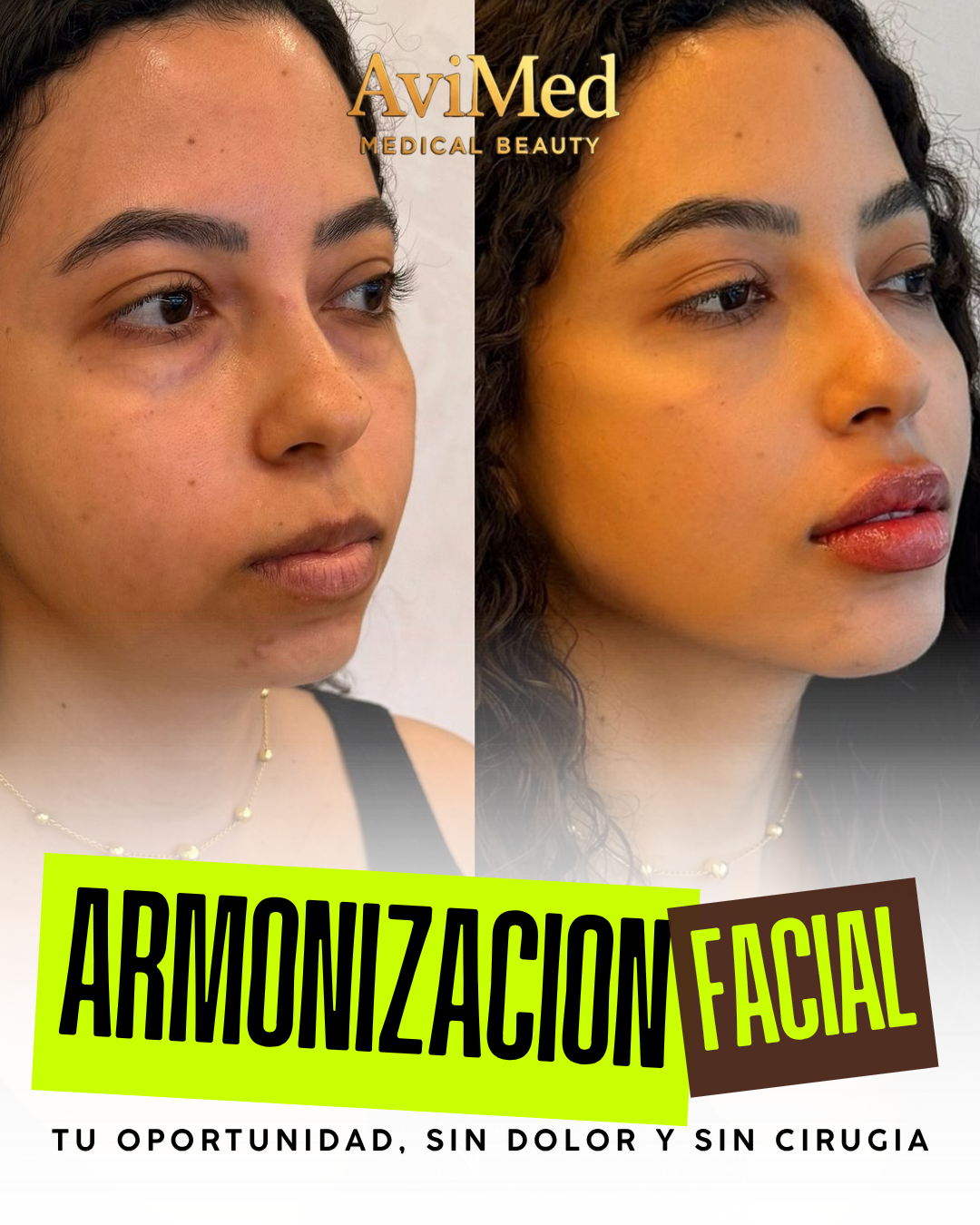 Armonización Facial