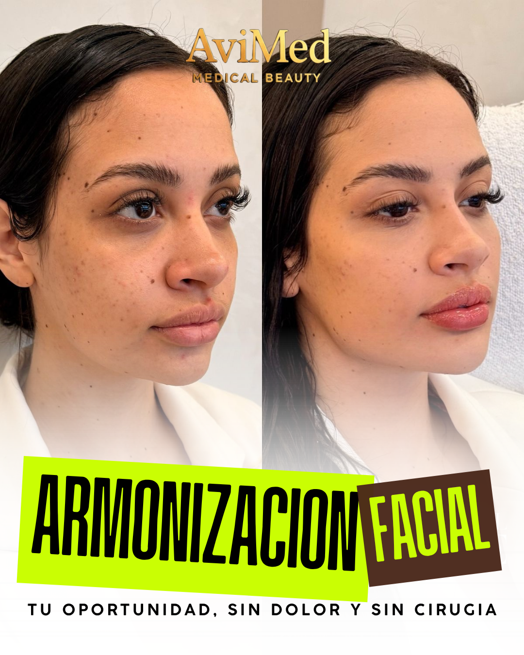 Armonización Facial