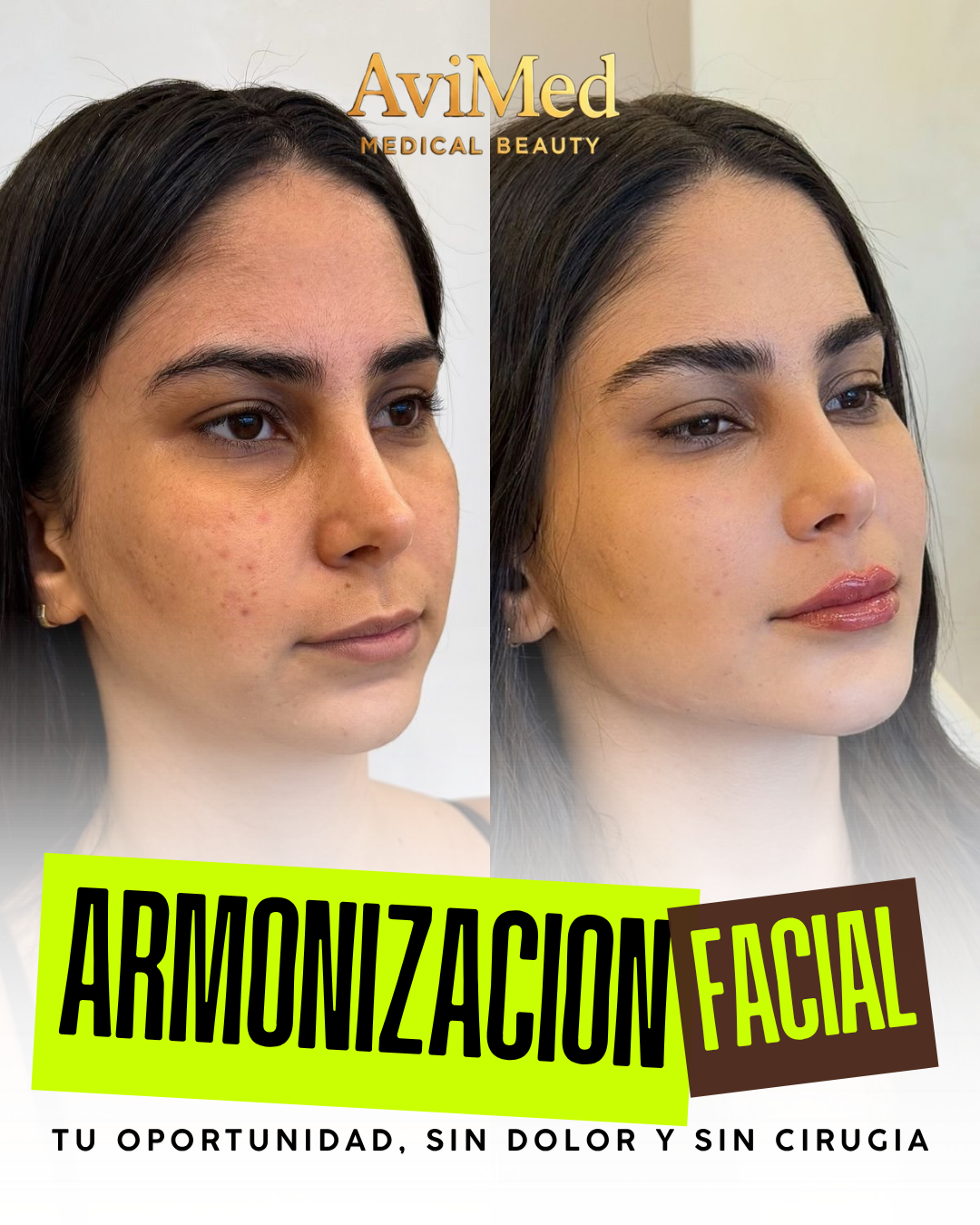 Armonización Facial
