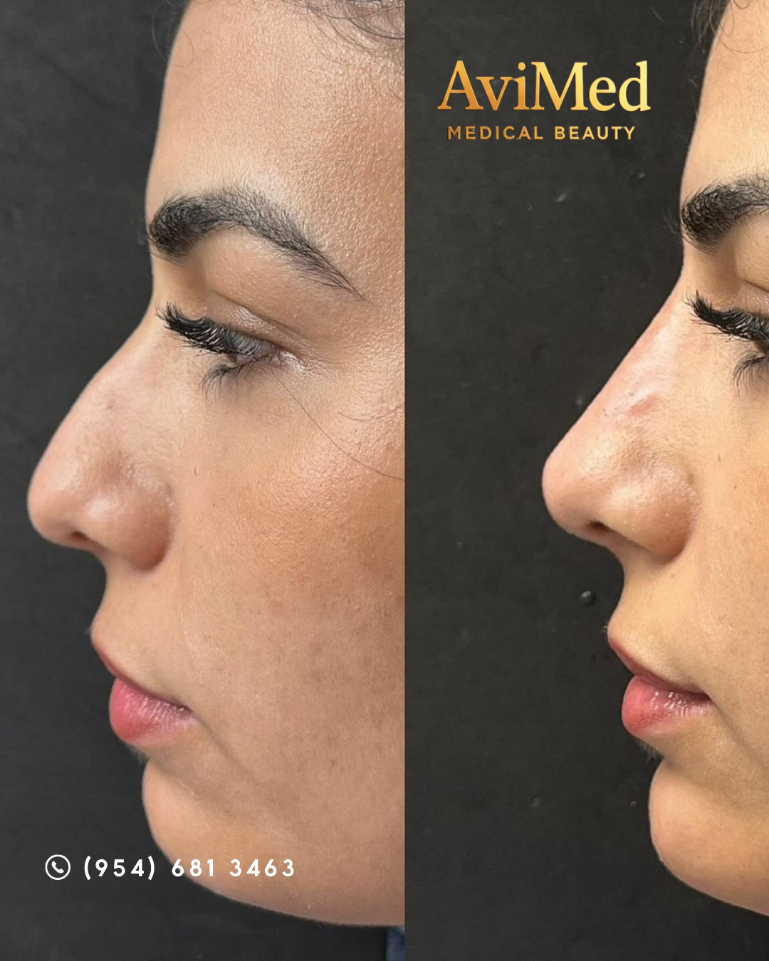 Rinoplastia sin Cirugía
