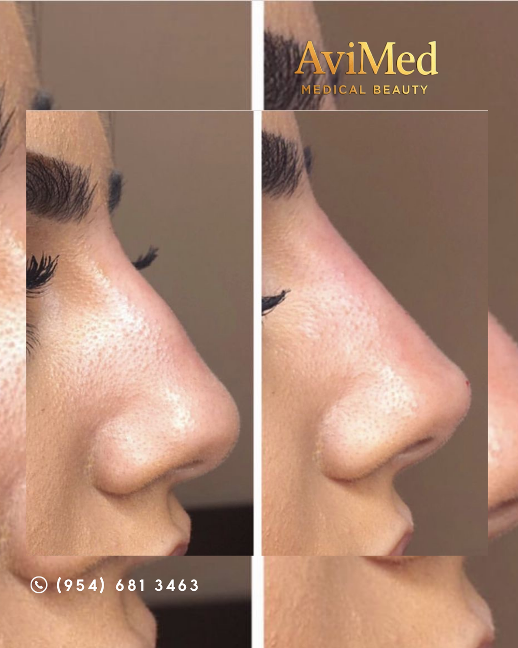 Non-Surgical Rhinoplasty