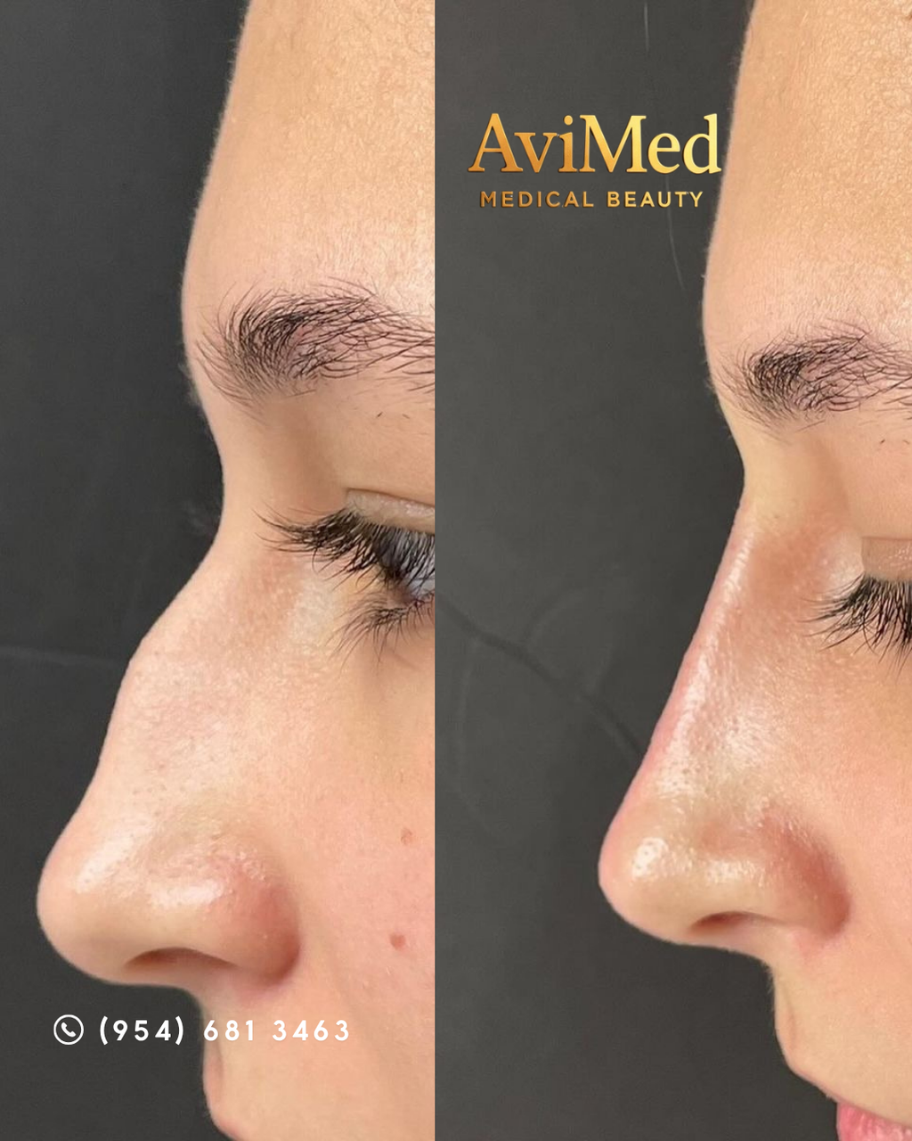 Non-Surgical Rhinoplasty