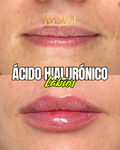 Relleno de Labios