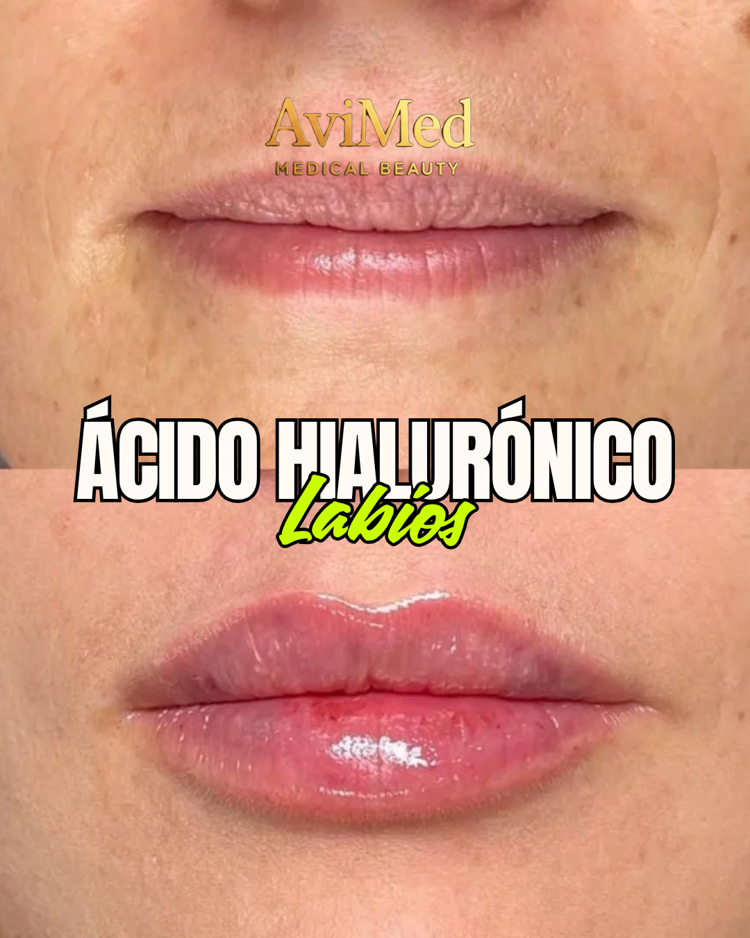 Relleno de Labios