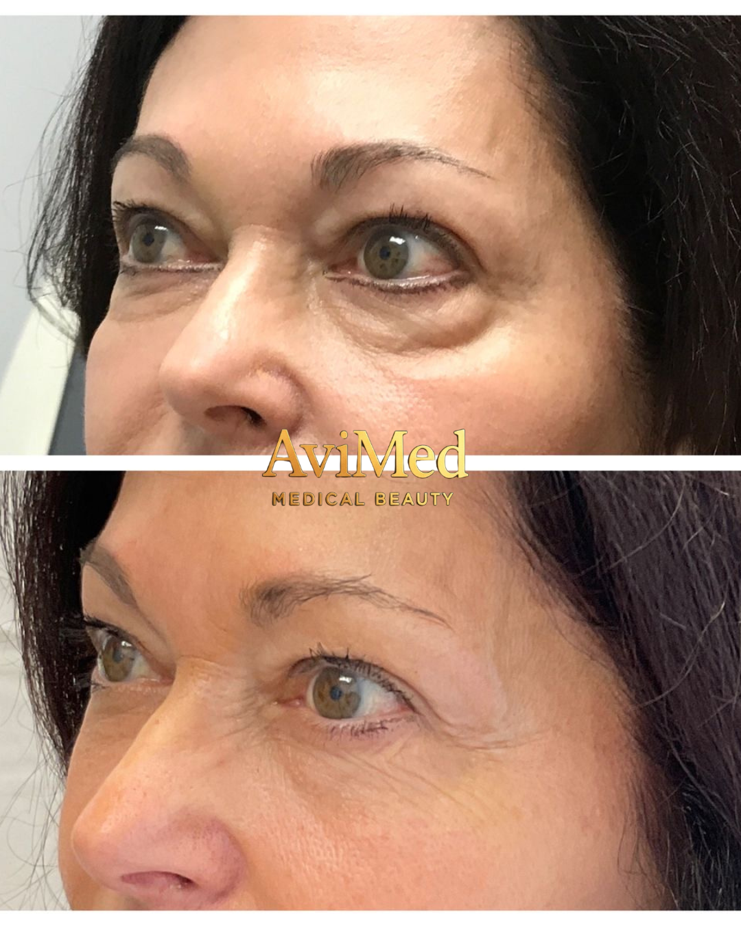 Eliminación de Ojeras - Exosomas