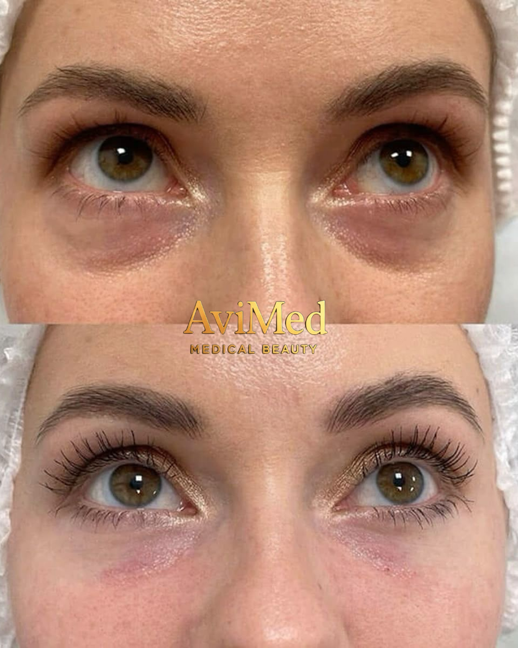 Eliminación de Ojeras - Exosomas