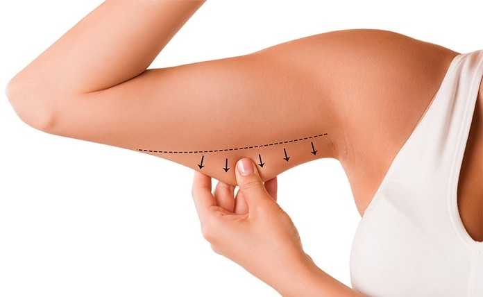 Lipo de Brazos - Endolift