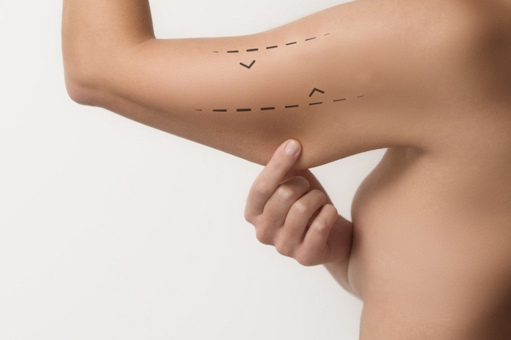 Lipo de Brazos - Endolift